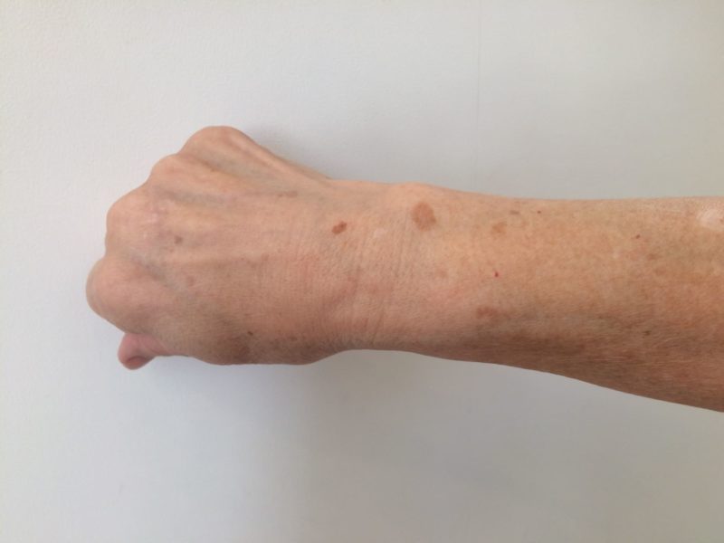 腕に点々と存在しているシミ