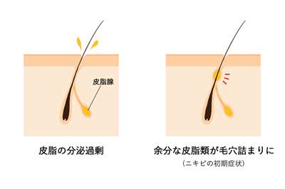 皮脂の過剰分泌から毛穴が詰まる仕組み